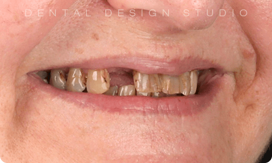 dental implant in cancun